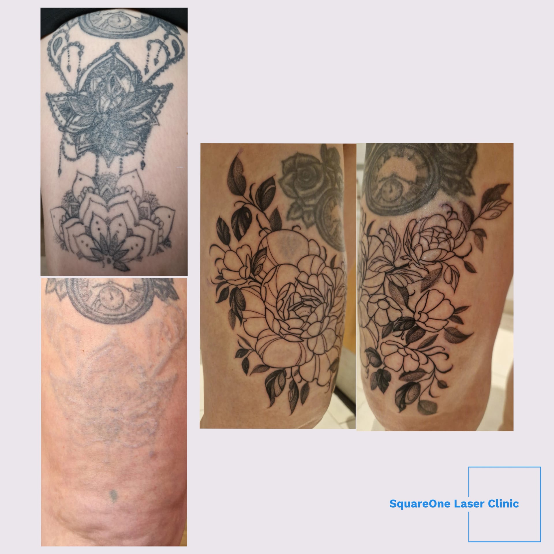 tattoo removal before and after 5