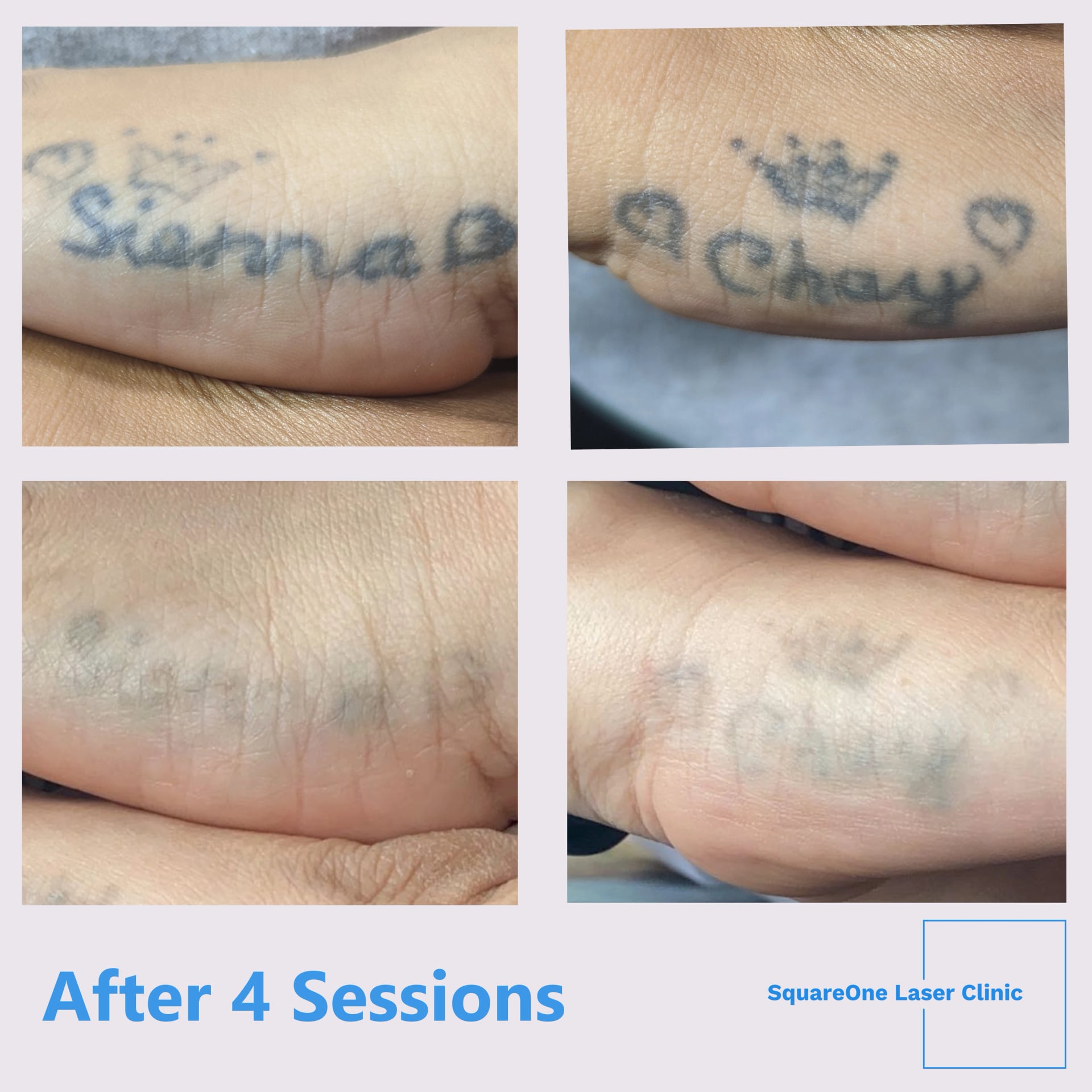 tattoo removal before and after 4