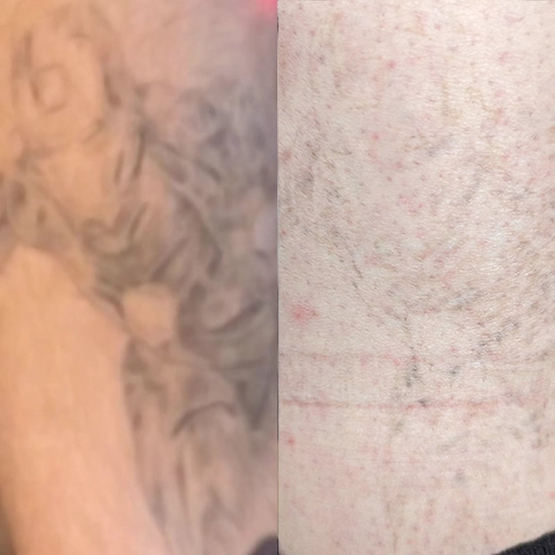 tattoo removal before and after 2