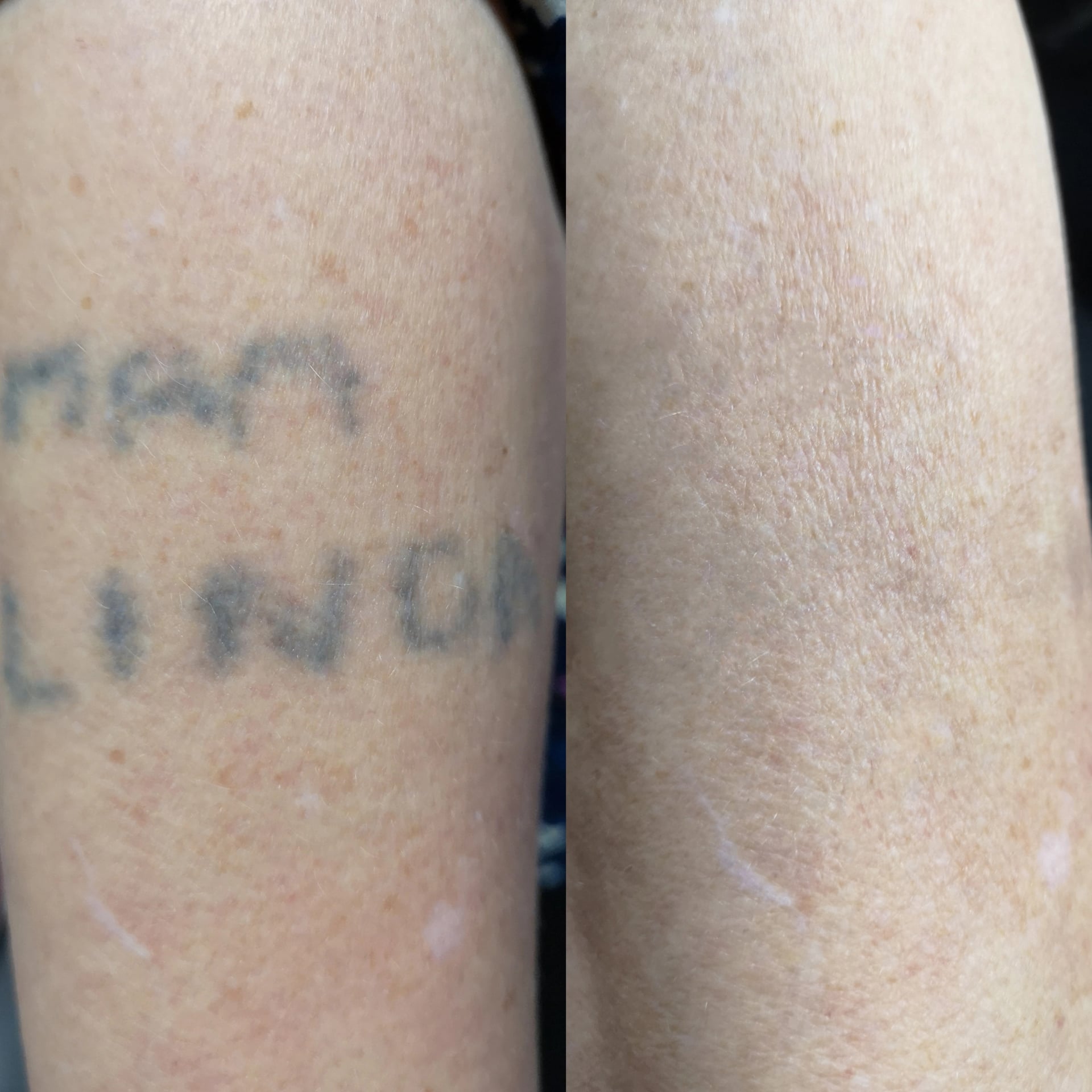 tattoo removal before and after