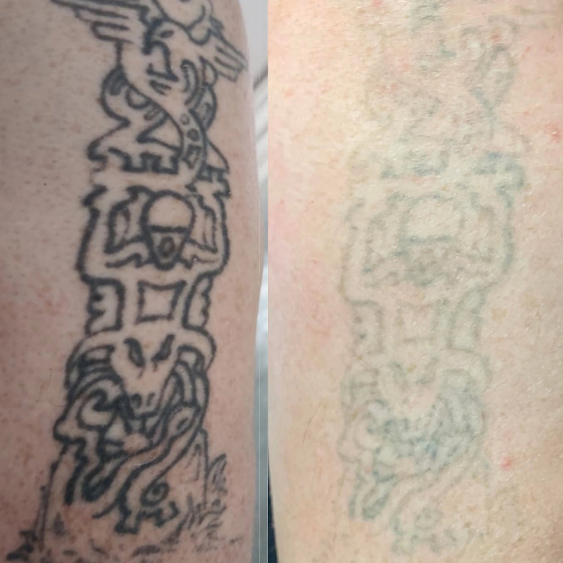 tattoo removal before and after 3