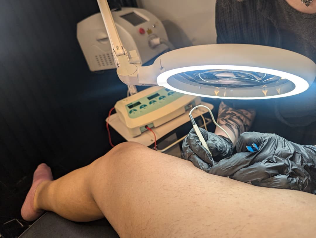 photo of electrolysis treatment happening on a leg